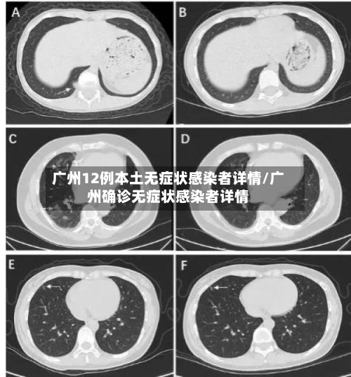 广州12例本土无症状感染者详情/广州确诊无症状感染者详情