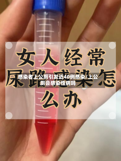 感染者上公厕引发近40例感染/上公厕会感染性病吗