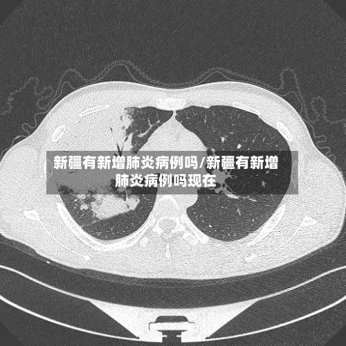新疆有新增肺炎病例吗/新疆有新增肺炎病例吗现在