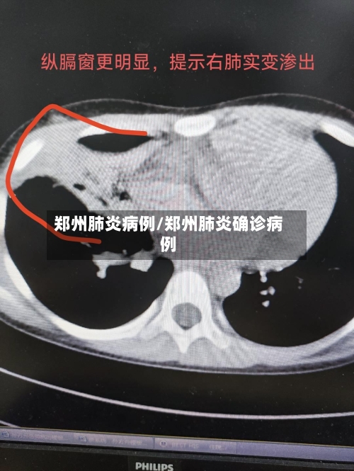 郑州肺炎病例/郑州肺炎确诊病例