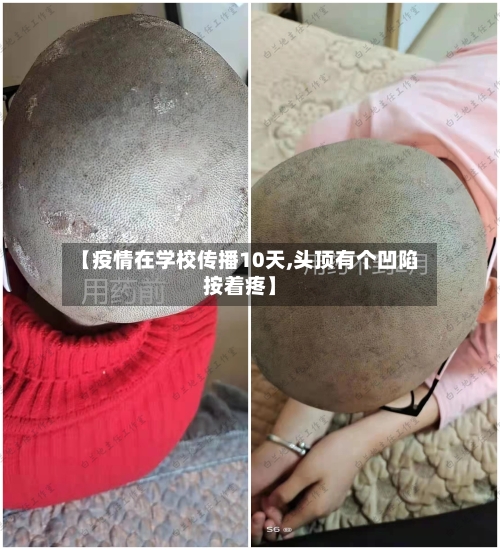 【疫情在学校传播10天,头顶有个凹陷按着疼】-第2张图片